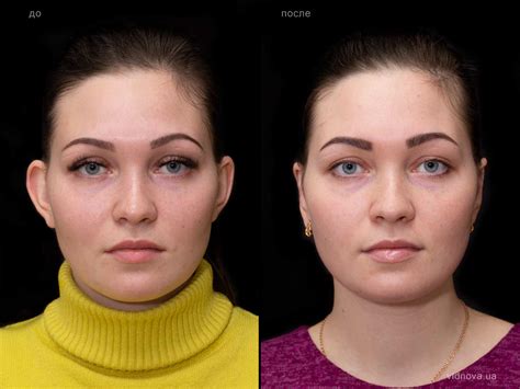 Физиологические изменения формы ушей после 30 лет