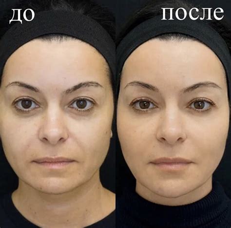Филлеры для овала лица:
