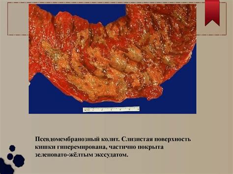 Финики и снижение риска развития язвенной болезни желудочно-кишечного тракта