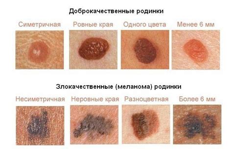 Функции родинок на коже