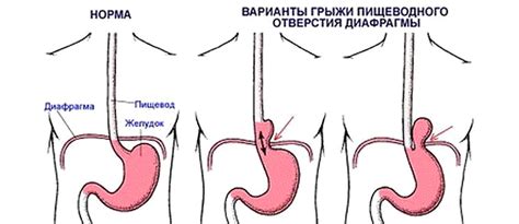 Цикорий при грыже пищевода