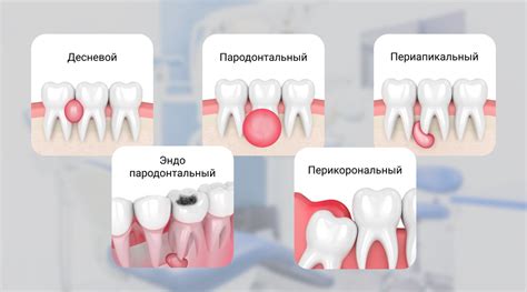 Чем полоскать нарыв на десне