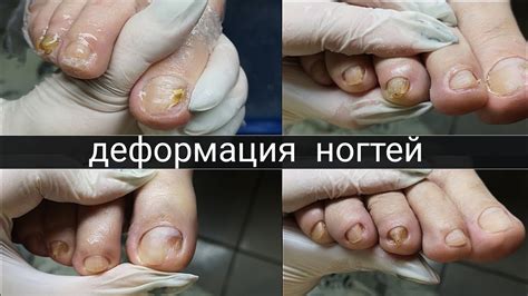 Чернение ногтей больших пальцев на ногах