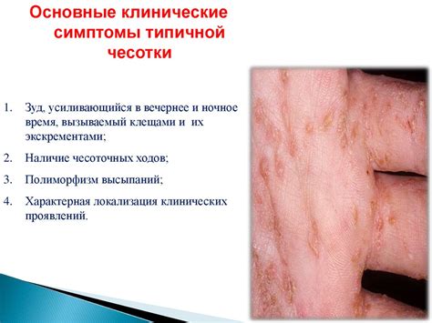 Чесотка: инфекционное заболевание кожи