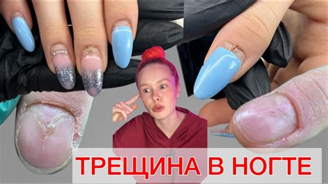 Что делать при оторванном ногте
