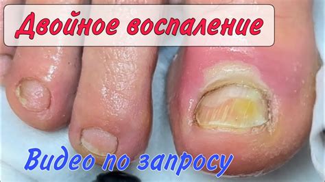 Что приводит к покраснению и отеку пальца на ноге