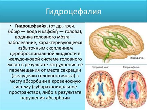 Что такое наружная заместительная гидроцефалия и как ее лечить