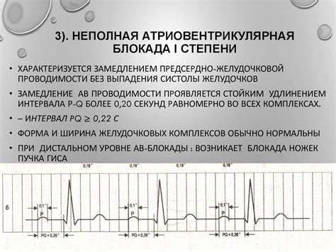 Что такое нарушение внутрипредсердной проводимости на ЭКГ