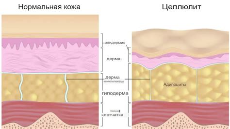 Что такое целлюлит и как он появляется