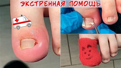 Экстренные меры: первая помощь при оторванном ногте