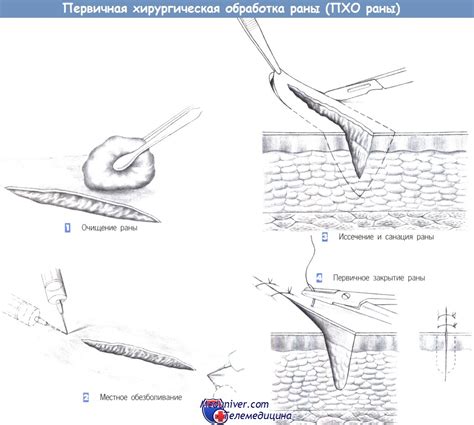 Этапы обработки раны