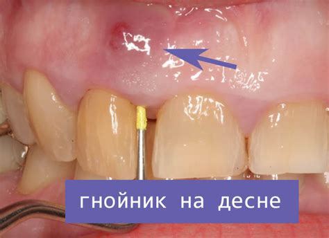 Эффективные методы и средства для обработки нарыва на десне