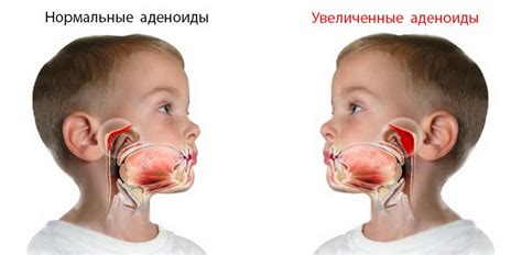 Как определить, что аденоиды возросли после их удаления 