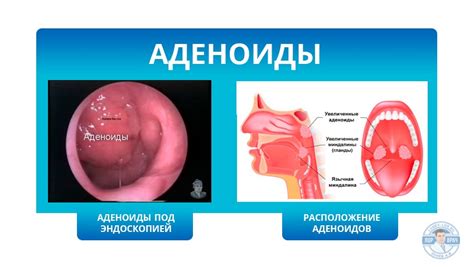  Распространенные проявления и симптомы заболевания аденоидами 